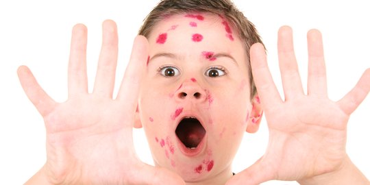 Bahayakah jika orang dewasa terserang cacar air?