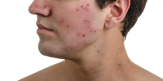Waspada, jerawat bisa jadi tanda awal diabetes