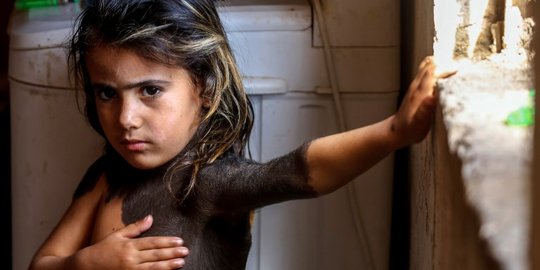 Derita bocah miskin Irak idap penyakit kulit langka