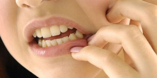 Bersihkan karang gigi dengan 3 perawatan ala rumahan ini