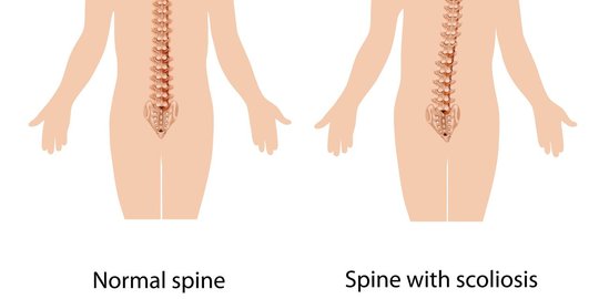 Skoliosis bisa menyebabkan payudara terlihat besar sebelah