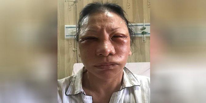 Ratna Sarumpaet dipukuli, Gerindra minta polisi bertindak tak pandang bulu