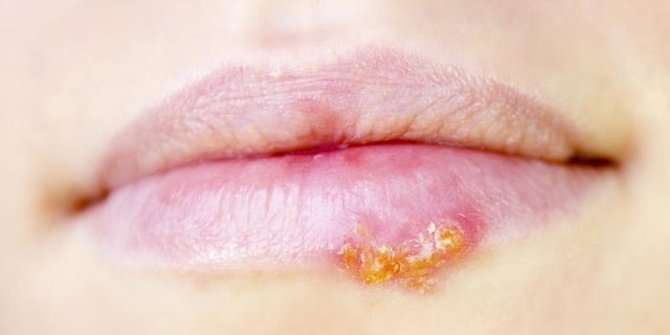 6 Hal Penting Yang Perlu Diketahui Tentang Penyakit Herpes Merdeka Com