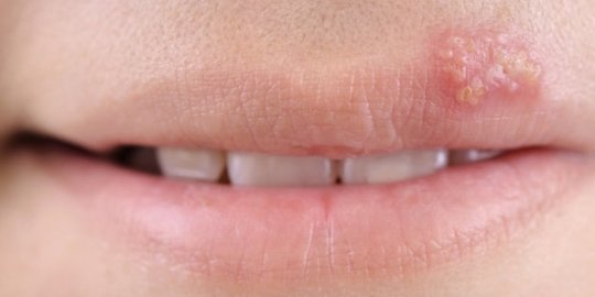 6 hal penting yang perlu diketahui tentang penyakit herpes
