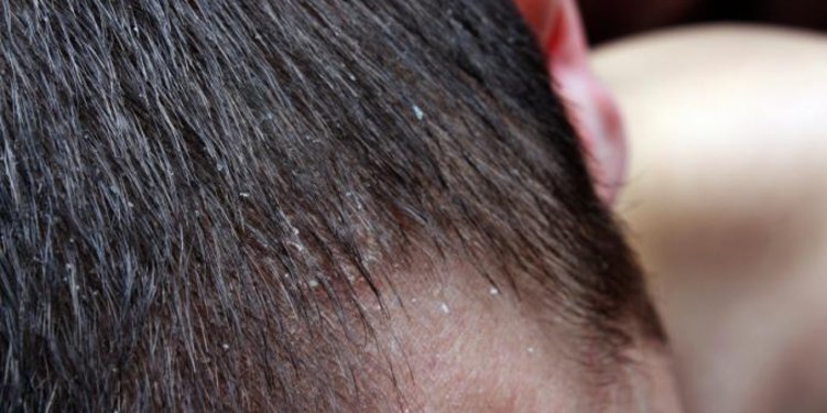 5 Bahan Yang Mampu Redakan Masalah Ketombe Membandel Di Kepala Merdeka Com