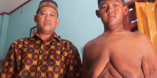 Sukses Diet, Ini Masalah Baru Arya Bocah Obesitas Asal Karawang