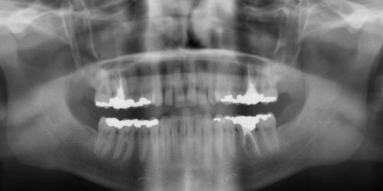 Pentingkah Melakukan Tindakan Radiologi pada Gigi?