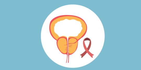 Kenali Jenis Kanker Prostat Serta Cara Mengatasinya