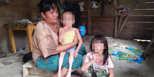 Dua Anak Yatim Miskin di Nias Utara Alami Gizi Buruk