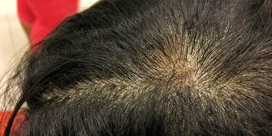 dermatitis seboroik