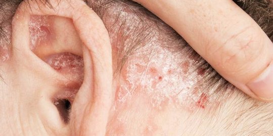psoriasis
