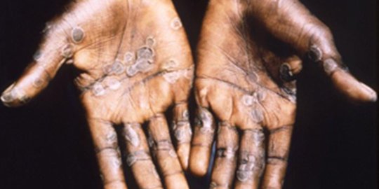 Mengenal Penyakit Cacar Monyet atau Monkeypox yang Baru Saja Masuk Singapura