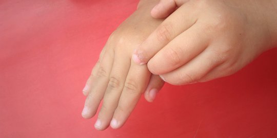 Dermatitis Atopik, Penyakit Gatal Kulit yang Biasanya Terjadi pada Anak