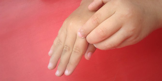 Dermatitis Atopik Penyakit Gatal Kulit Yang Biasanya