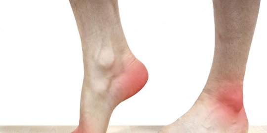 keseleo atau kaki yang alami masalah tulang rev3