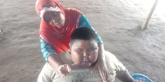Ibunda Satia, Bocah Obesitas di Karawang Tolak Anaknya Dioperasi
