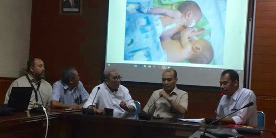 Tim Dokter Optimistis Pemisahan Bayi Kembar Siam Adam Malik Sukses