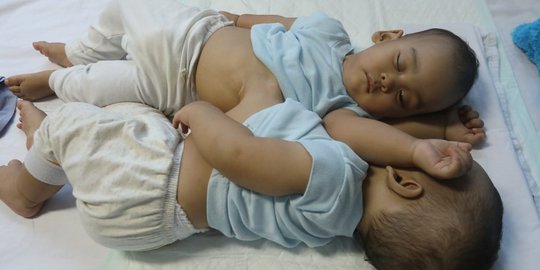 Bayi Kembar Dempet Perut Adam-Malik Berhasil Dipisahkan