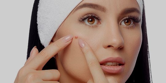 6 fakta seputar jerawat yang penting untuk kamu ketahui