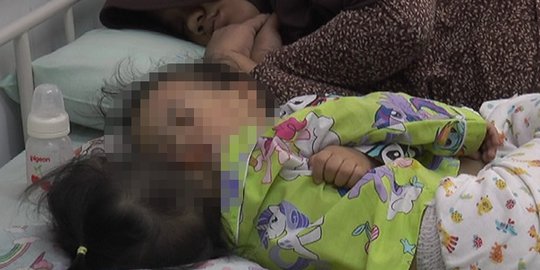 Pagi Ini, Bayi Kembar Siam Akila dan Azila Jalan Operasi Pemisahan