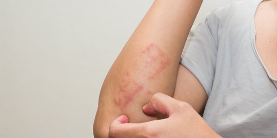 Tak Hanya Diderita Anak, Dermatitis Atopik Juga Bisa Dialami Lansia