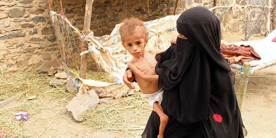 Meratapi Bayi Malnutrisi di Yaman Tubuhnya Tinggal Tulang dan Kulit