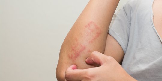 Sejumlah Hal yang penting Diketahui Orangtua Mengenai Dermatitis Atopik pada Anak