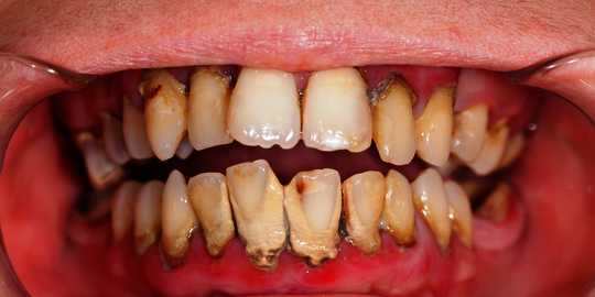 10 manfaat luar biasa yang bisa kamu peroleh dari konsumsi kismis