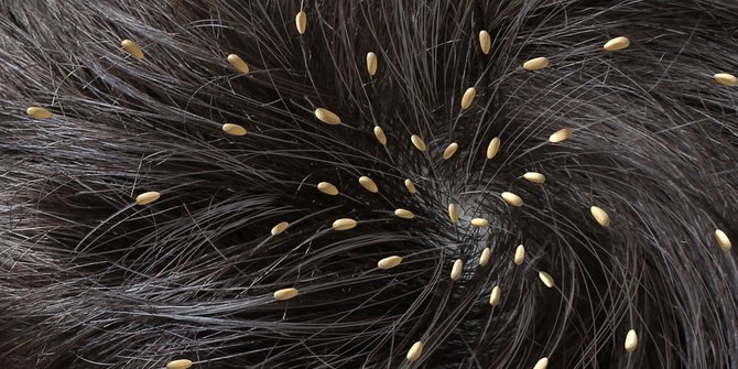 6 Hal yang Bisa Jadi Penanda Adanya Kutu Rambut di Kepalamu