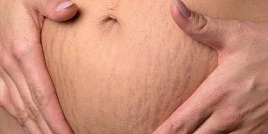 7 Cara Ampuh Hilangkan Stretch Mark