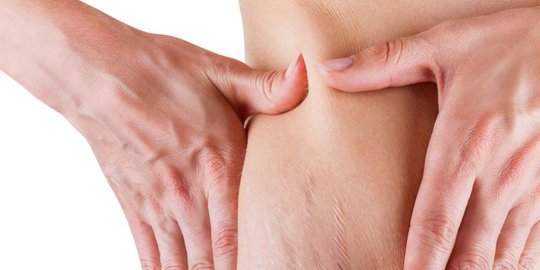 stretch mark eksfoliasi rev1