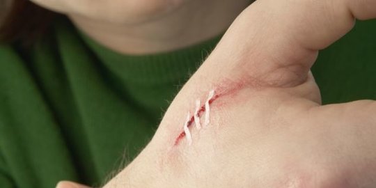 Cara Menghilangkan Keloid secara Medis dan Alami, Dijamin Efektif