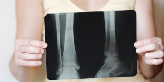 4 Cara Mudah Mencegah Munculnya Osteoporosis dan Menjaga Kesehatan Tulang