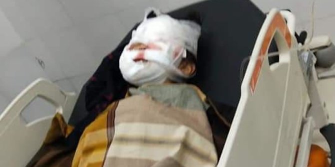 Bocah Korban Serangan Pit Bull Segera Jalani Operasi Lanjutan