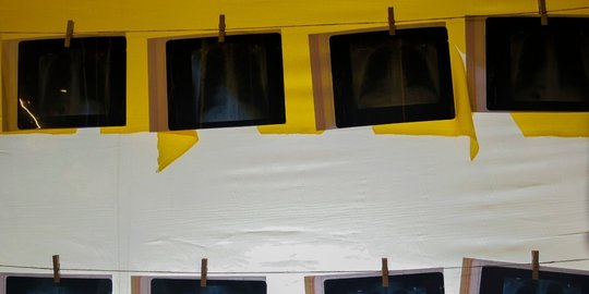 hitam vape komunitas pamer hasil rontgen