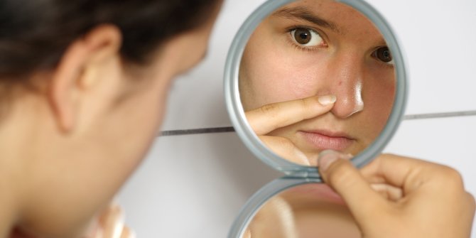 7 Cara Mengempeskan Jerawat Secara Alami, Enggak Bikin Repot