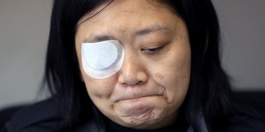 Jurnalis Indonesia yang Ditembak Polisi Saat Demo Hong Kong Buta Matanya dan Trauma