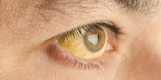 Benarkah Mata Kuning Merupakan Tanda Adanya Penyakit Hepatitis?