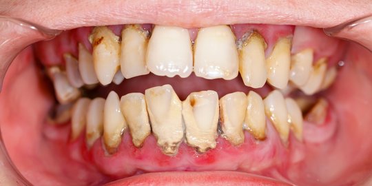 Benarkah Scaling Bisa Membuat Gigi Menjadi Lebih Tipis?