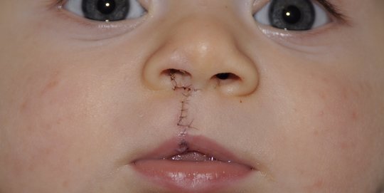 Usai Operasi Celah Bibir, Terapi Wicara Bisa Jadi Cara Tingkatkan Komunikasi Anak
