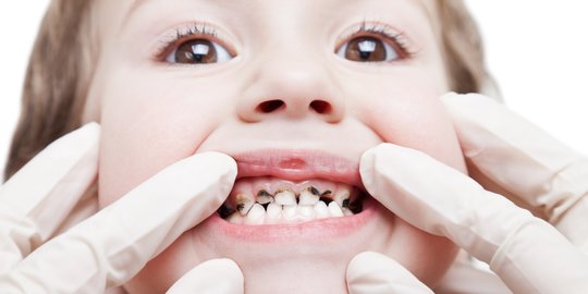 11 Tips Mengatasi Sakit Gigi Berlubang Dengan Alami Beserta Bahayanya Bila Diabaikan Merdeka Com