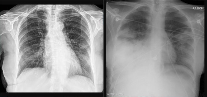 3 penyebab pneumonia dan gejalanya