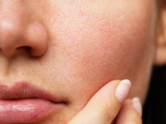 10 cara mengecilkan pori pori wajah secara alami
