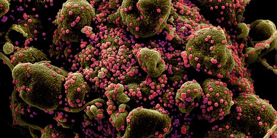 Begini Bentuk Sel Tubuh yang Terinfeksi Virus Corona