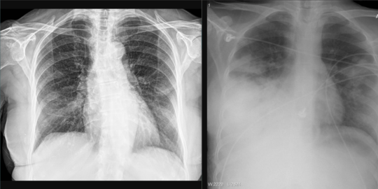 6 Nutrisi Penting untuk Cegah Pneumonia, Bahannya Mudah Ditemukan