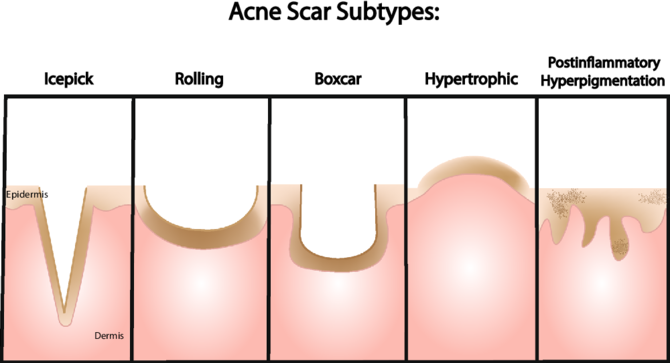 acne scar