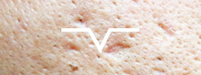 acne scar