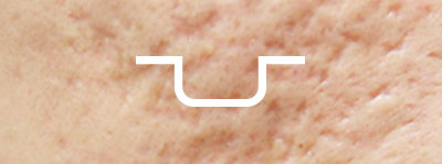 acne scar