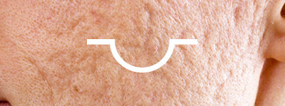 acne scar