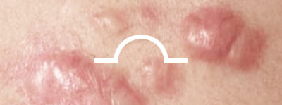 acne scar